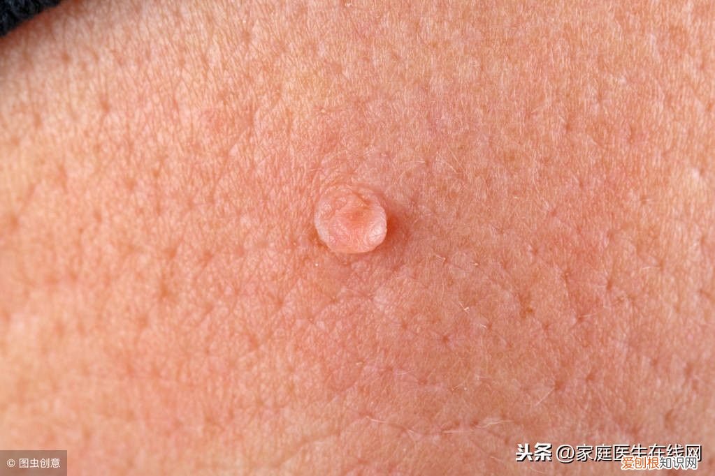 身上长了扁平疣怎么办 扁平疣的根治方法