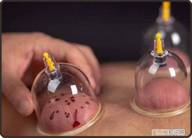 拔火罐的五个注意事项 拔火罐要注意什么呢