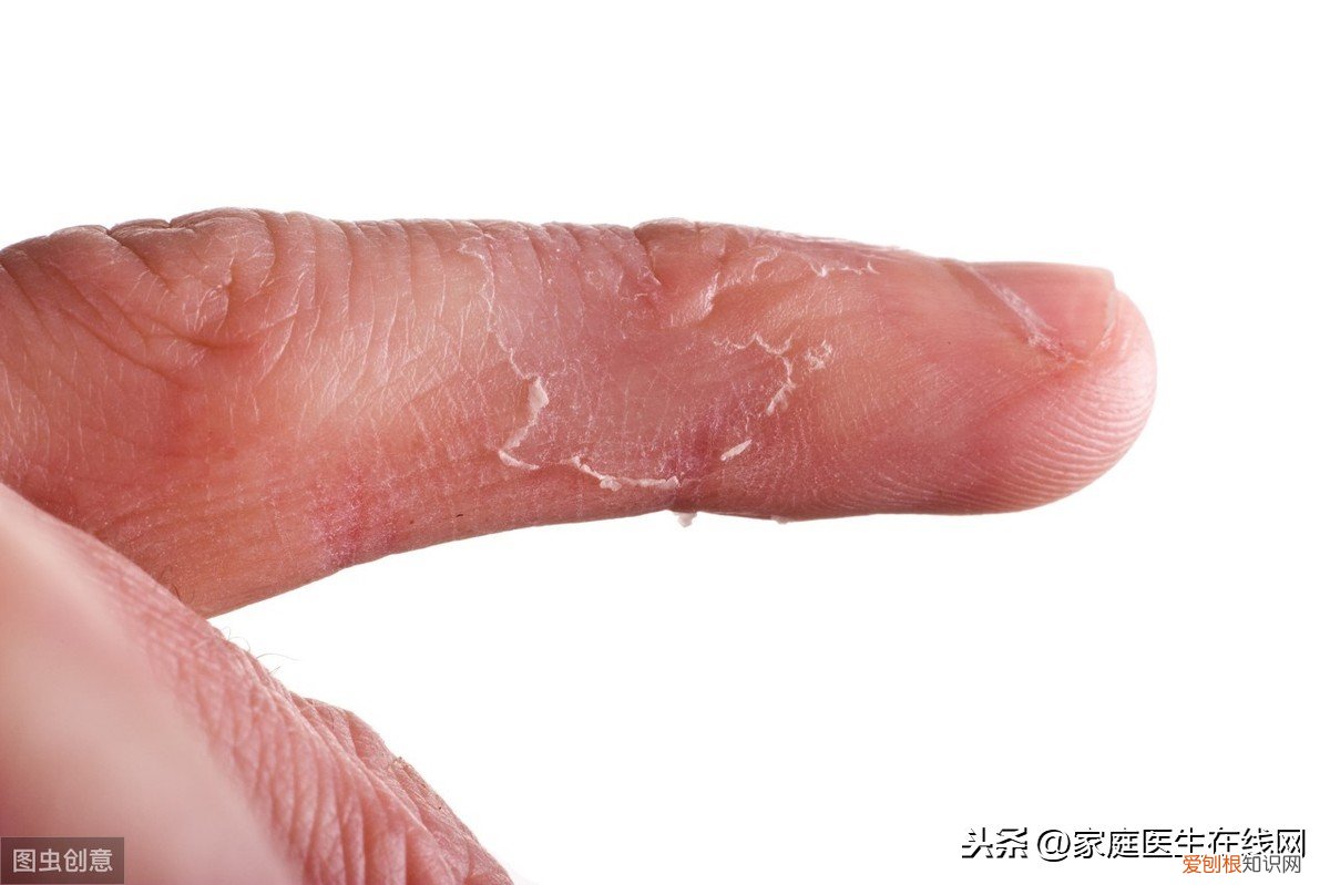 手脱皮是什么原因导致的？通常是缺乏这种维生素，补一补就好了