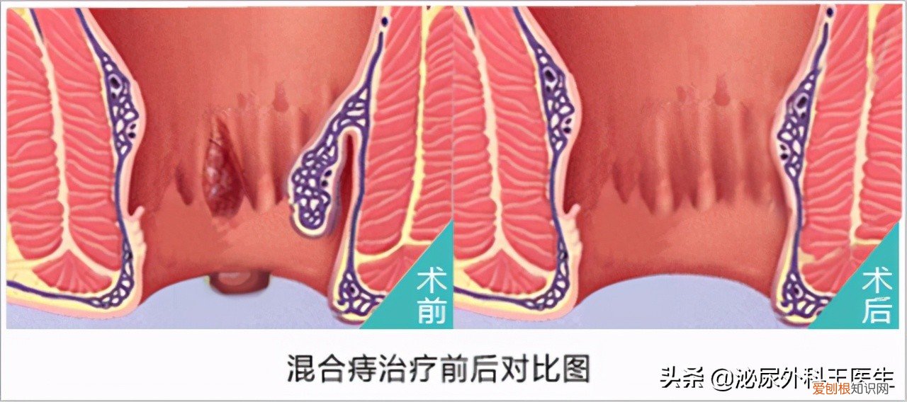 专家告诉你答案 痔疮最佳的自愈方法