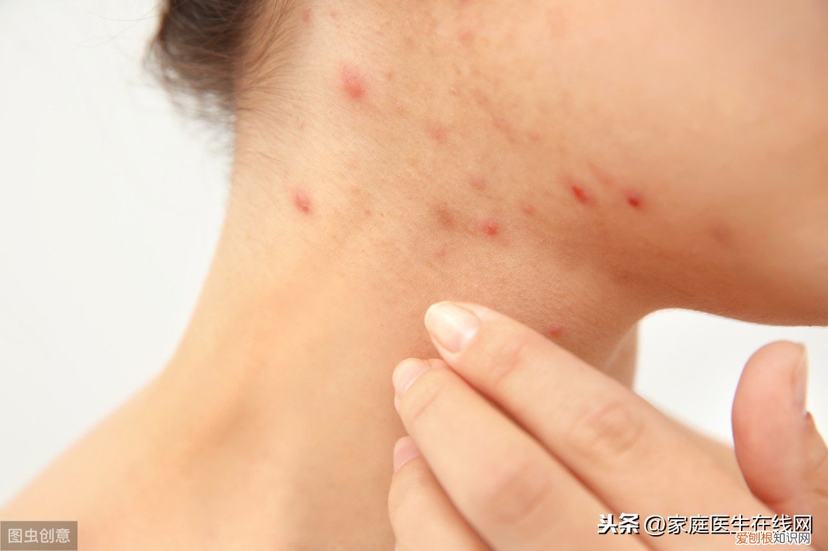 脖子上长痘痘什么原因？可能是这4种疾病在作怪