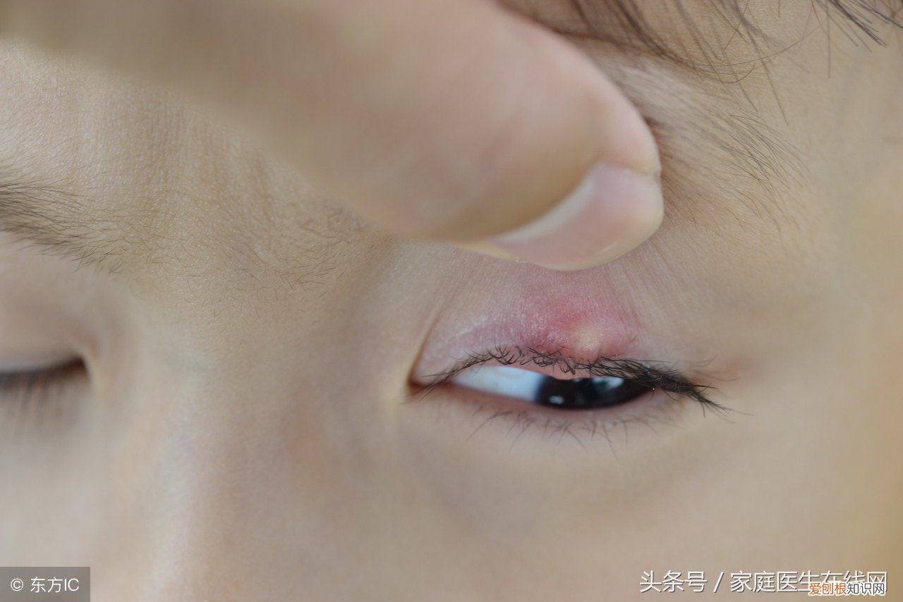 麦粒肿是什么原因引起？这4个原因，可以很好解释