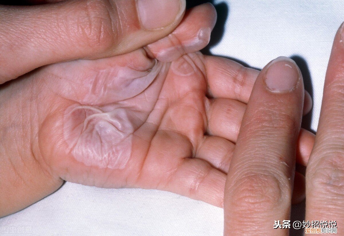 教您4个应急妙法，简单快速效果好 烫伤用什么方法好的最快