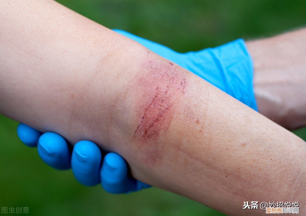 教您4个应急妙法，简单快速效果好 烫伤用什么方法好的最快