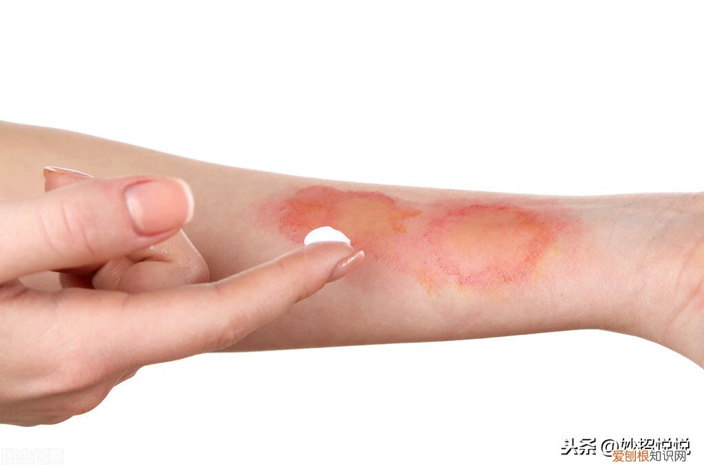 教您4个应急妙法，简单快速效果好 烫伤用什么方法好的最快