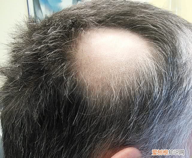 一夜白头是真的吗？压力过大会导致头发快速变白