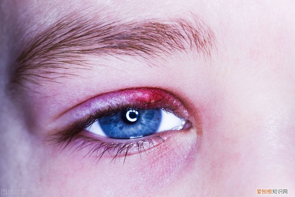 麦粒肿怎么消除快？教会你怎样快速治愈麦粒肿