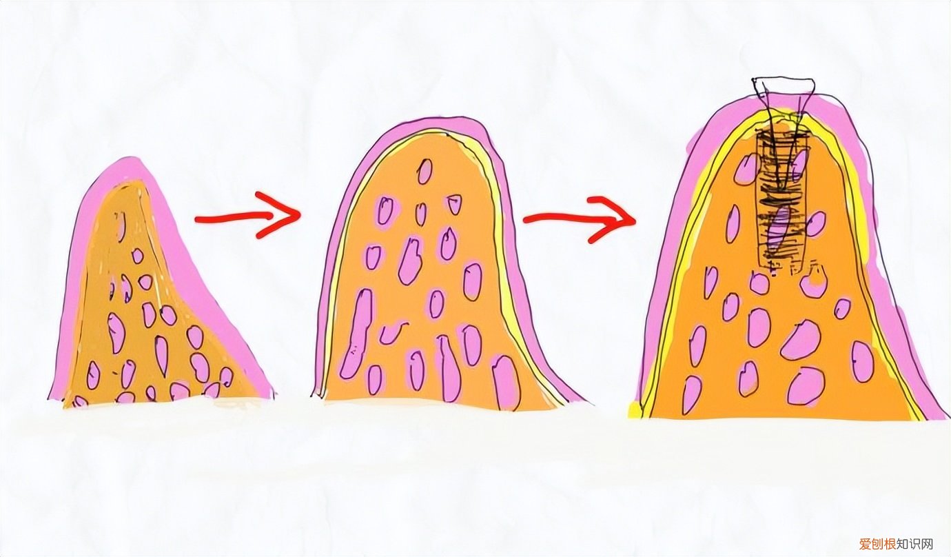 为什么有人是几千元，有人要几万 正常种一颗牙多少钱?