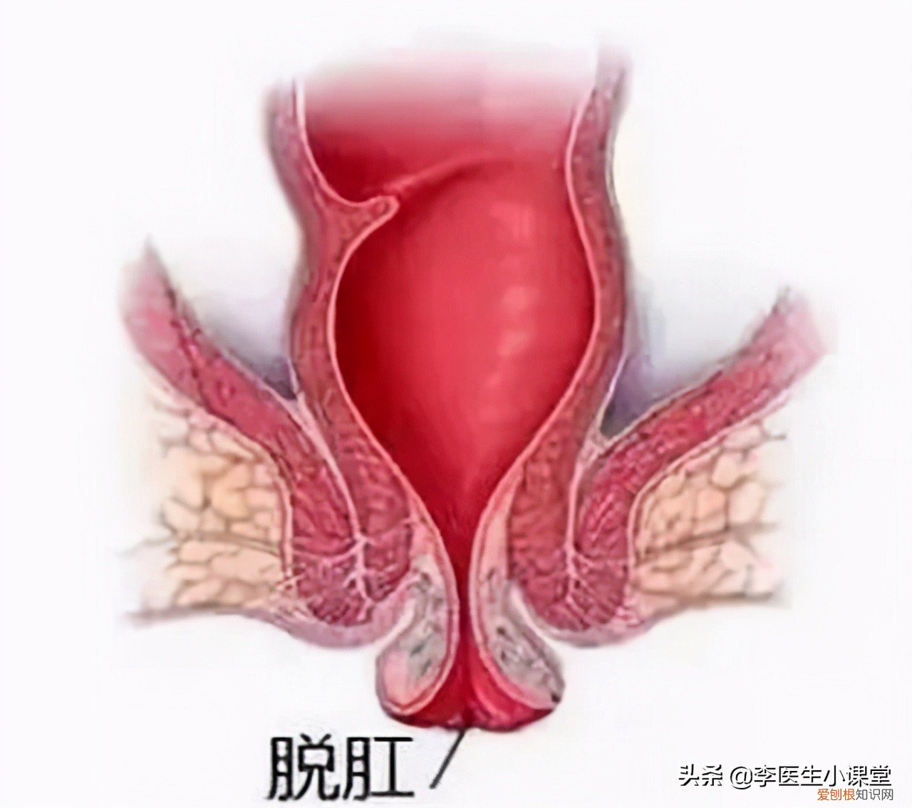 痔疮外痔肉球怎么消除?专家:2个方法这么用,痔疮肉球没有了