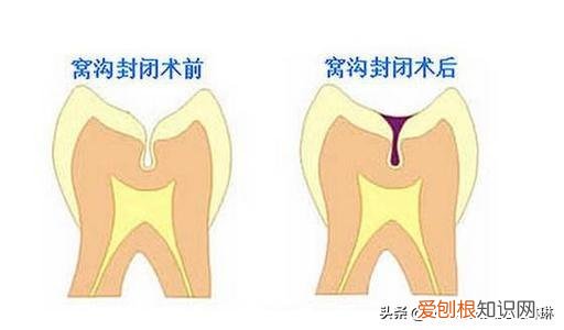 牙齿窝沟封闭,窝沟封闭后更容易烂牙