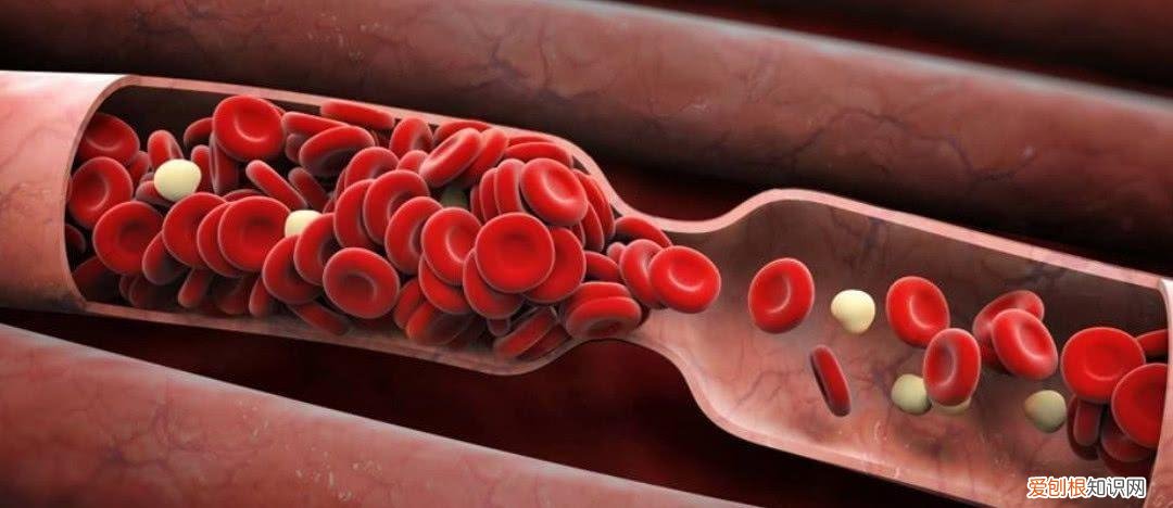 软化血管的5大误区您知道几个？提醒：延缓血管硬化需注意4点