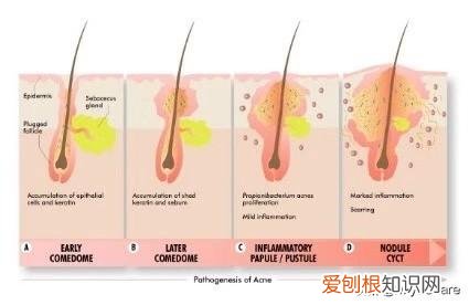 化妆品会闷痘吗？皮肤科医生解决了闷痘的真相