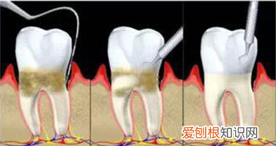 牙周炎能治好吗,牙周刮治的真实感受