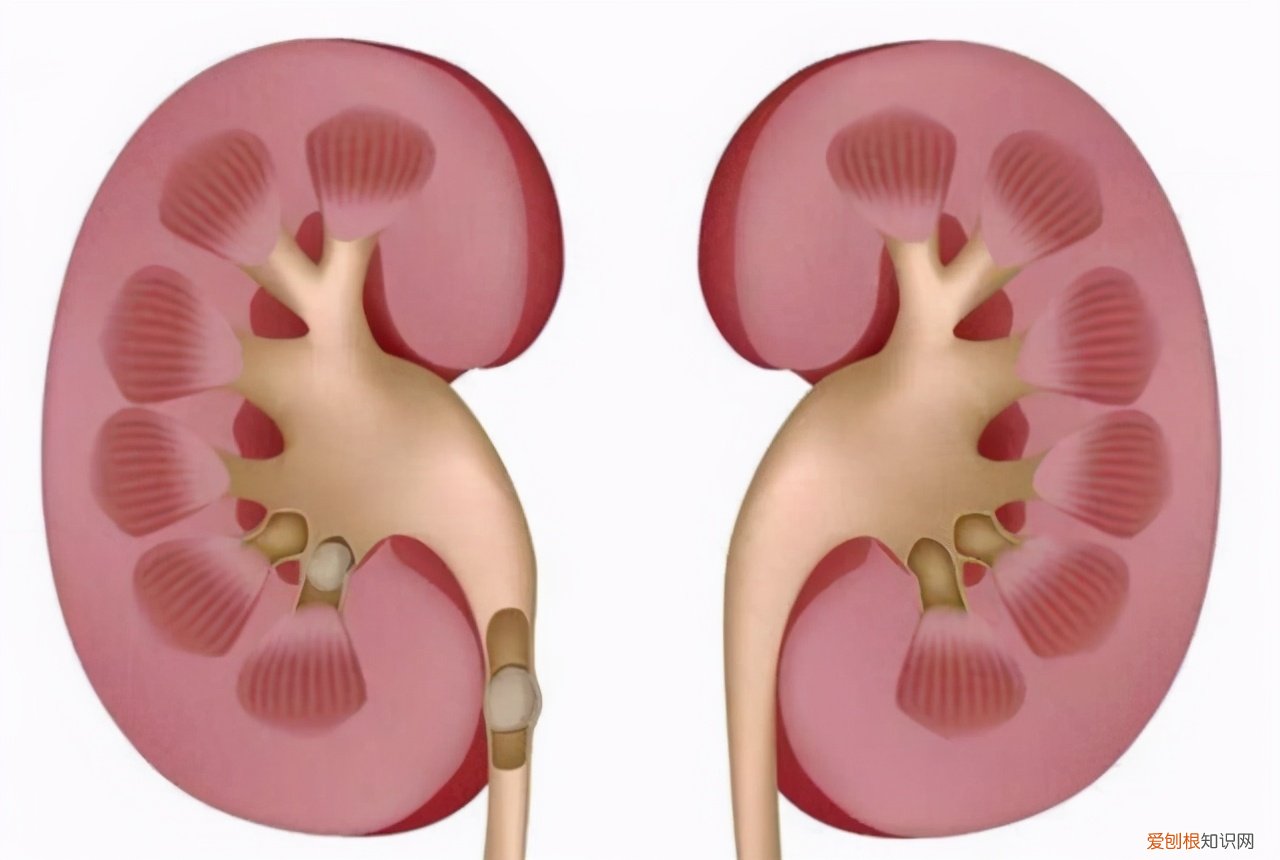 35岁男子尿酸高达860，肾衰入院