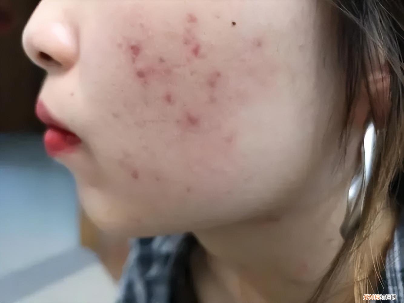 怎样去痘痘,快速去痘痘的小方法