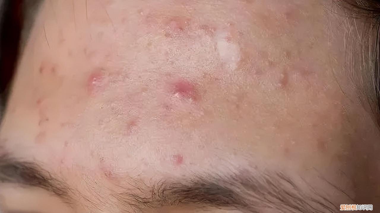 怎样去痘痘,快速去痘痘的小方法