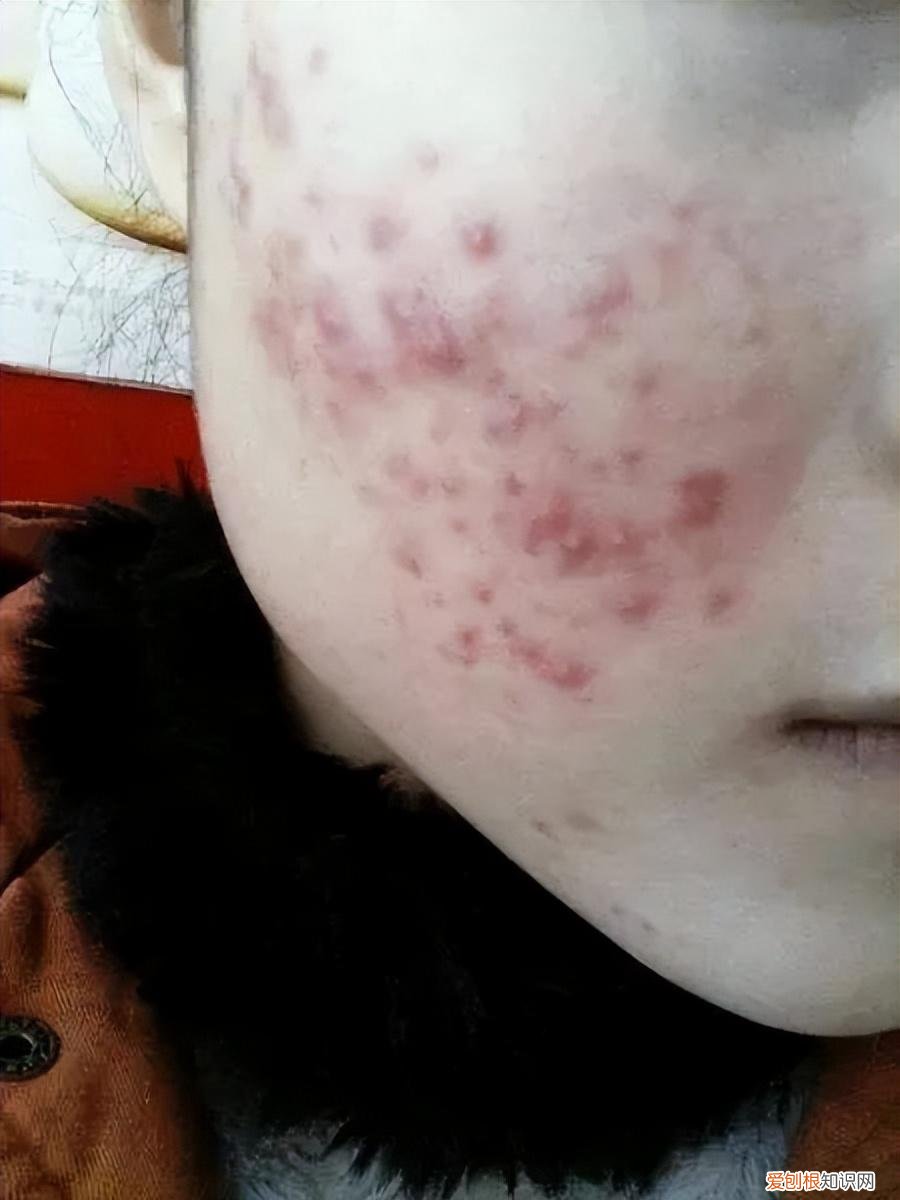 怎样去痘痘,快速去痘痘的小方法