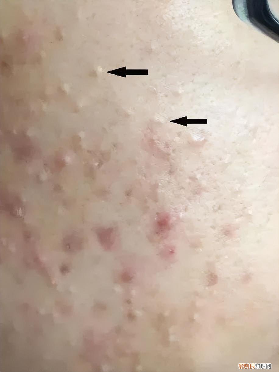 怎样去痘痘,快速去痘痘的小方法