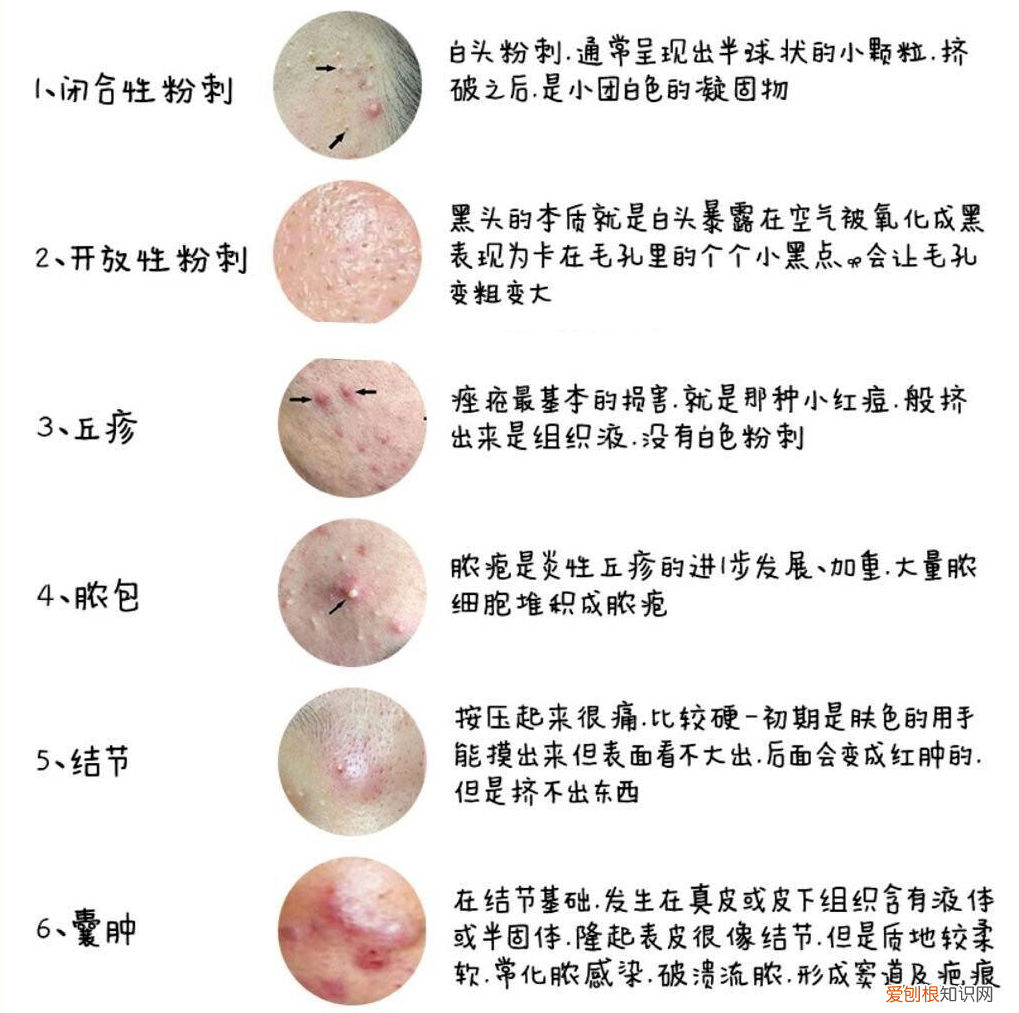 怎样去痘痘,快速去痘痘的小方法