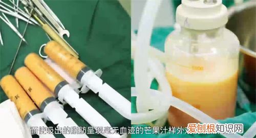 腹部抽脂后为什么感觉麻 腹部抽脂后为什么肚子还是大