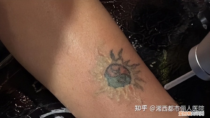 去医院洗纹身价格 哪里洗纹身好