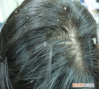治疗头皮痒的小窍门 头皮痒怎么办小窍门