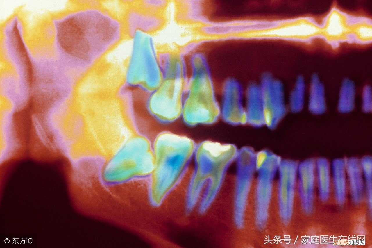 为什么有些人会长智齿，长智齿会有什么影响 每个人都有智齿吗