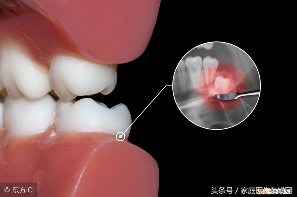 为什么有些人会长智齿，长智齿会有什么影响 每个人都有智齿吗