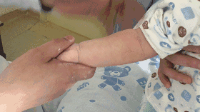 小儿高热退烧推拿手法 小儿高烧39度推拿手法图解