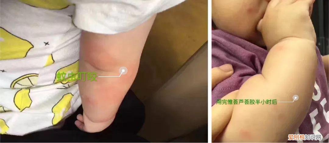 每天晚上坚持涂芦荟胶的效果 芦荟胶对痘痘和痘印有效果吗