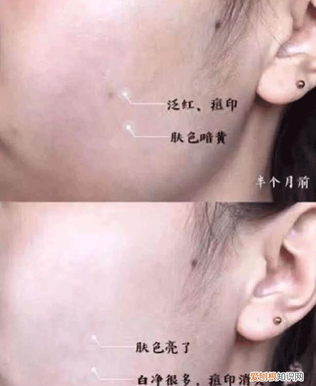 每天晚上坚持涂芦荟胶的效果 芦荟胶对痘痘和痘印有效果吗