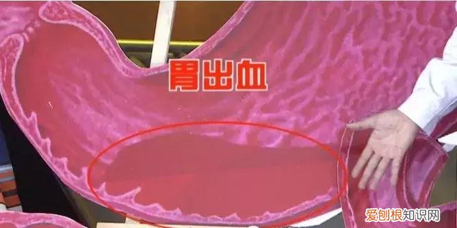 众所周知，多吃腌制食品会导致胃癌。多吃盐会导致胃癌吗？