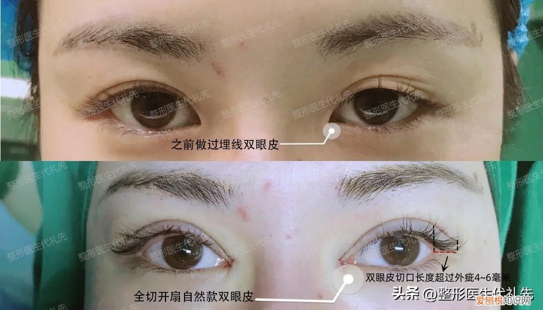 切双眼皮多久能恢复自然