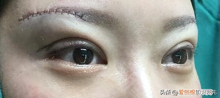 切双眼皮多久能恢复自然