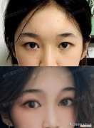 切双眼皮多久能恢复自然