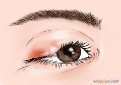 麦粒肿偏方绑手指正确方法