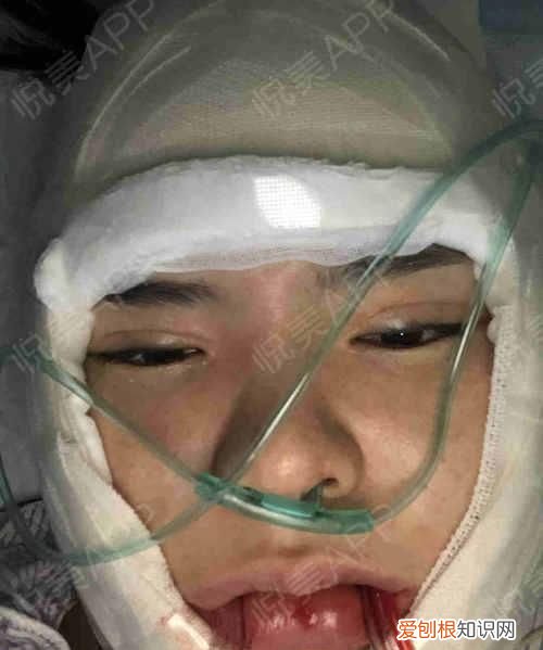 颧骨内推能推平吗 颧骨内推不建议推平