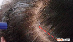 剪发虫怎么除掉，怎样去除剪发虫长什么样