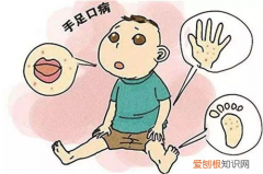 小儿手足口病是怎么引起的 手足口病的注意事项