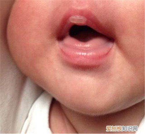 嘴上起泡怎样快速下去嘴上起泡可以涂牙膏吗