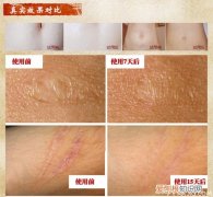 小偏方:去疤痕精油的功效及使用方法，去疤精油怎么使用