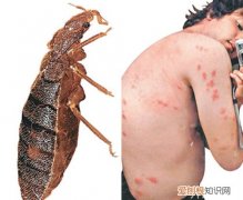 【生活资讯】臭虫咬了怎么治简单实用,不看别后悔！