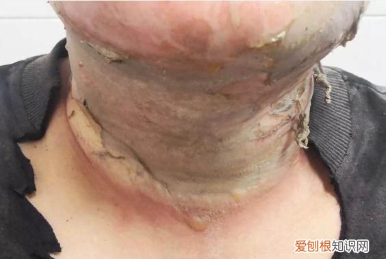 疫情当前小心酒精变炸弹