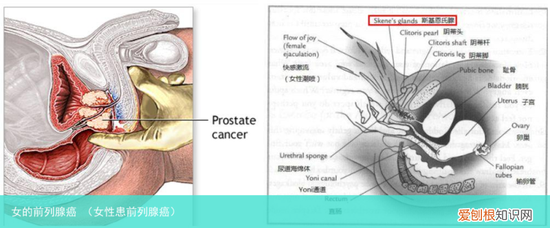 女性患前列腺癌 女的前列腺癌