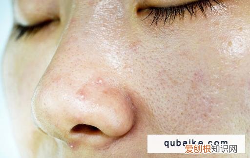 如何缓解毛孔粗大问题 毛孔粗大该怎么办,毛孔粗大怎么缓解
