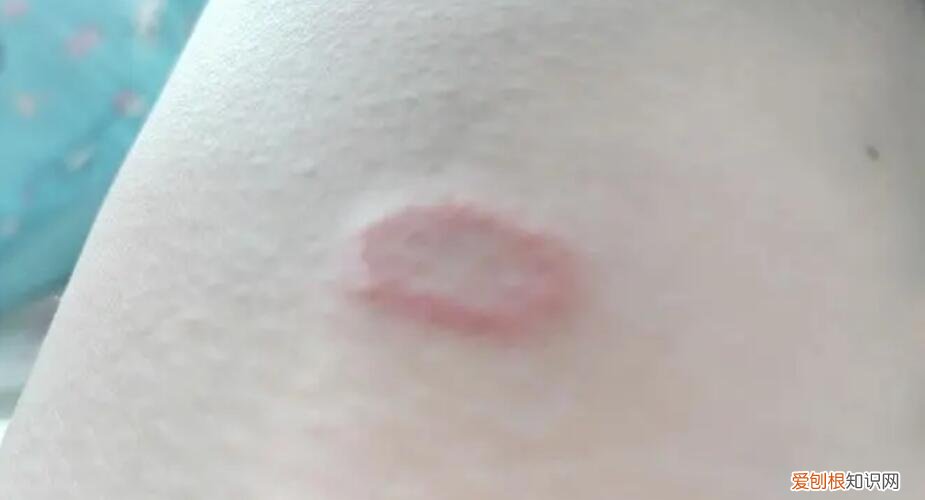 人得了猫癣能不能彻底治好 ，人得了猫癣严重有什么后果？