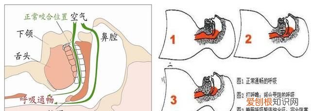 病态打呼噜,怎么判断是恶性打呼