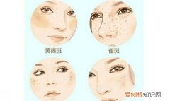 黄褐斑如何治疗