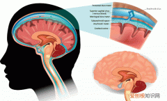 脑脊膜动静脉瘘，蛛网膜位于哪个部位