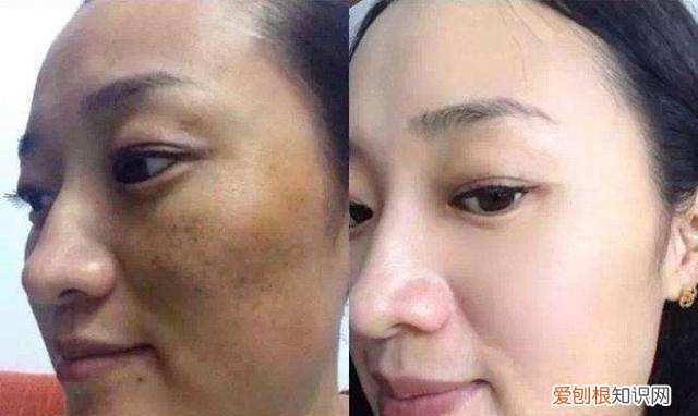 开塞露能去脸上的斑点和皱纹吗